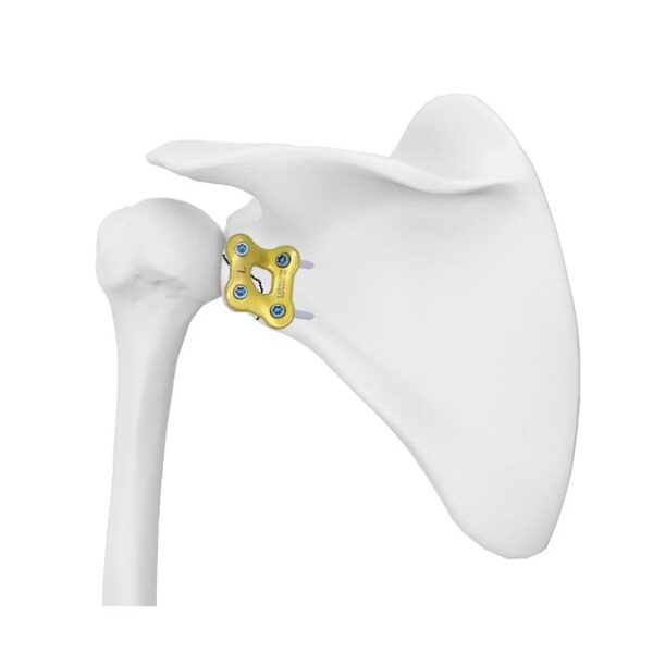 Placa de bloqueo glenoideo