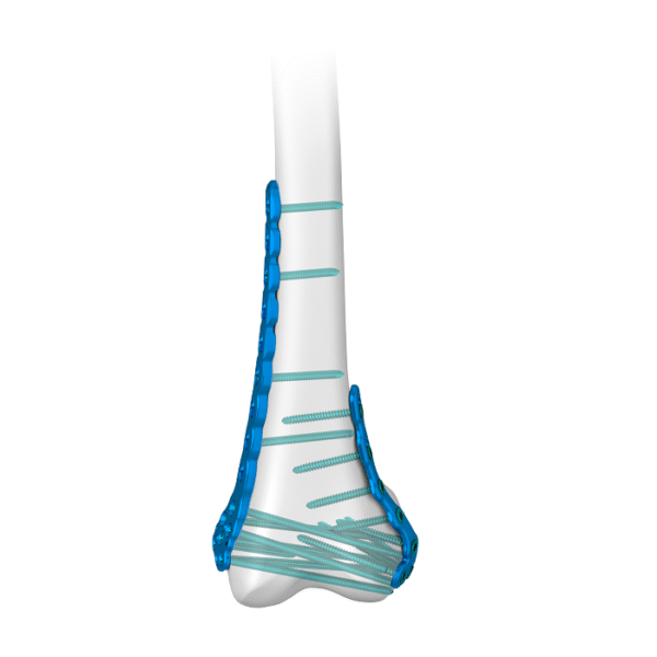 Sistema de placa de bloqueo femoral distal