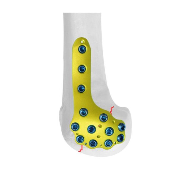 Placa Bloqueada Femoral Distal Lateral Condilar