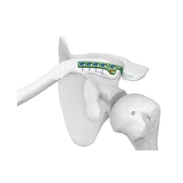 Placa Bloqueada Clavicular con Gancho II