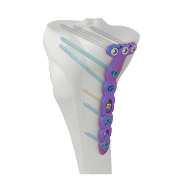 Placa de bloqueo tibial medial proximal VAL